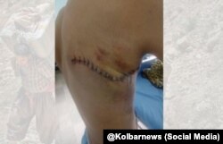 میلاد حسینی، کولبر۱۶ ساله اهل دیواندره که بر اثر تیرندازی ماموران جمهوری اسلامی از ناحیه کتف و پشت زخمی شده است