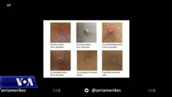 Çfarë është lija e majmunit? 