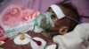 FILE - A malnourished girl receives treatment at a feeding center at Al-Sabeen hospital in Sanaa, Yemen, Nov. 3, 2020. 