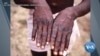 US Expands Monkeypox Response After WHO Declares Emergency