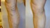 Varicose veins before and after treatment