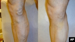 Varicose veins before and after treatment