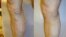 Varicose veins before and after treatment
