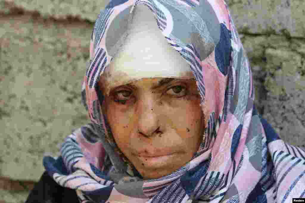An injured displaced woman from Qayyara poses for a picture in Qayyara, Iraq.