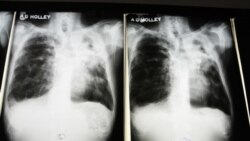 Tuberculose no namibe - 1:39