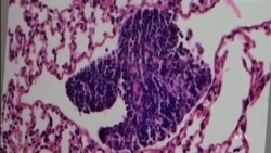 VOA英语视频: 科学家发现阻止癌细胞扩散的奥秘