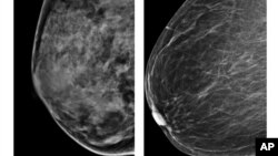 زنانی که بافت پستان آنها متراکم تر است، خطر ابتلا به سرطان پستان در آنها بیشتر است. تصویر سمت چپ، پستان متراکمتر را نشان می دهد.