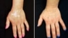 After five months of treatment with tofacitinib, the discoloration on a vitiligo patient's hands improved dramatically. (Credit: Brett King, Yale University)