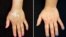 After five months of treatment with tofacitinib, the discoloration on a vitiligo patient's hands improved dramatically. (Credit: Brett King, Yale University)
