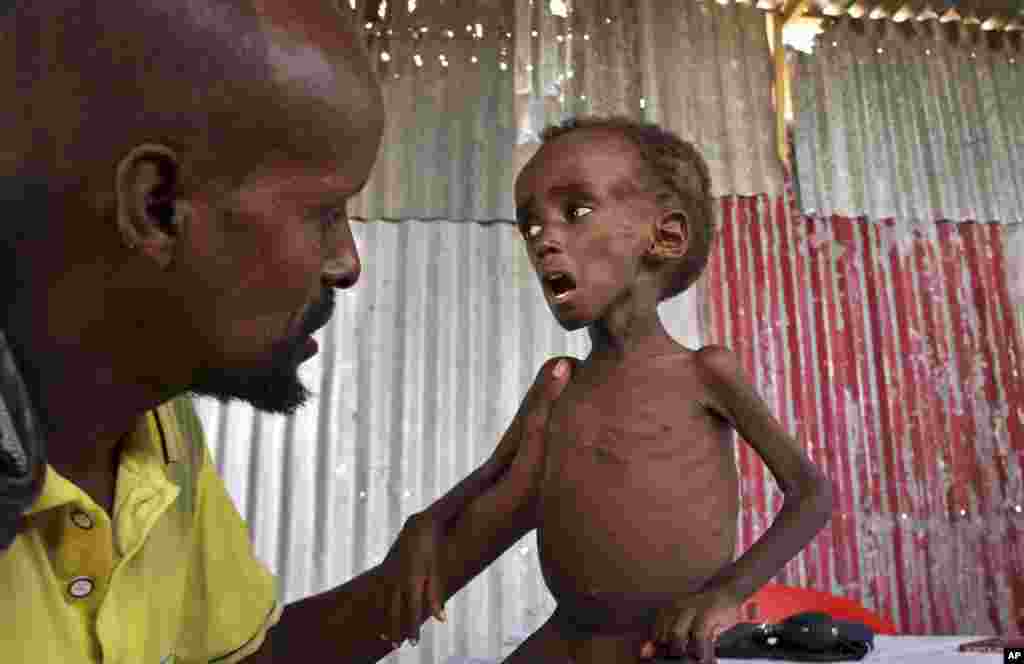 Ali Madey memegang anaknya yang menderita kurang gizi parah, Mohamed Ali (5 tahun) di kamp pengungsi di pinggiran Mogadishu, Somalia.