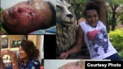 Meseret Nigusse after and before the accedent 