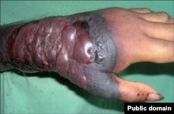 የኢቦላ ሕመምተኛ እጅ