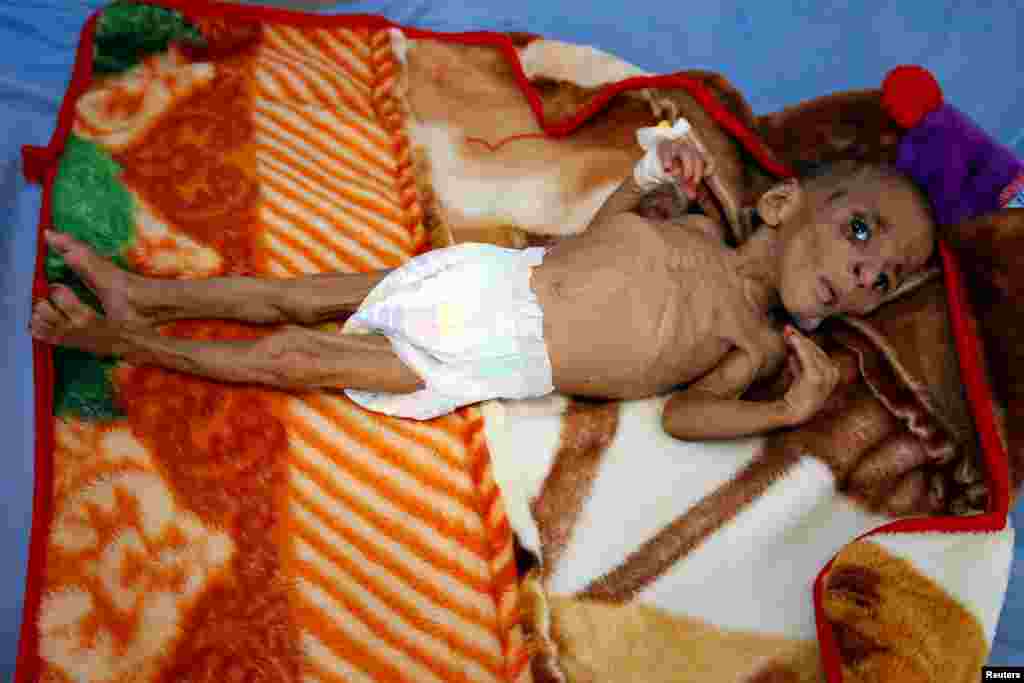 ទារក​អាយុ​មួយ​ខួប​ Fatima Abdullah Hassan ដែល​ទទួល​រង​ពី​កង្វះ​ចំណីអាហារ​​ គេង​នៅ​លើ​គ្រែ​ក្នុង​មជ្ឈមណ្ឌល​ព្យាបាល​កង្វះ​ចំណីអាហារ​នៅ​ទីក្រុង​កំពង់ផែ Red Sea នៃទីក្រុង​ Hodeida ប្រទេស​យេម៉ែន។