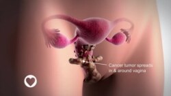 LAFIYARMU: : Yankin Kudu Da Hamadar Sahara Ne Ke Da Mafi Yawan Masu Fama Da Cutar Kansar Mahaifa A Duniya 