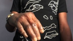 Patient, Michael Sunday, shows his new prosthetic hand at Immortal Cosmetic Art, in Uyo, Nigeria January 7, 2020.