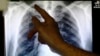 File - A doctor points to an x-ray showing a pair of lungs infected with tuberculosis in Ladbroke Grove in London, England.