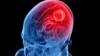 FILE - Image of a brain tumor.
