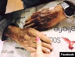 한국 전 당시 남아프리카공화국에서 공군 대장으로 참전했다가 북한 군에 포로로 잡혀 갖은 고문을 당했던 데니스 얼프 씨의 손등에 고문의 흔적인 흉터가 남아있다. 사진 출처 = 한나 김 씨 페이스북.