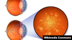 የስኳር ሕመምና የዓይን ብርሃንን እስከ ማጣት ሊያደርሱ የሚችሉ የዓይን በሽታዎች