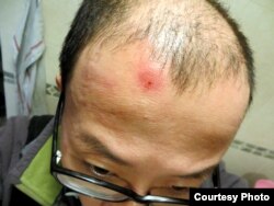 胡佳被打伤的头部 (胡佳提供)