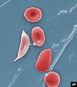 This 2009 colorized microscope image made available by the Sickle Cell Foundation of Georgia via the Centers for Disease Control and Prevention shows a sickle cell, left, and normal red blood cells of a patient with sickle cell anemia.