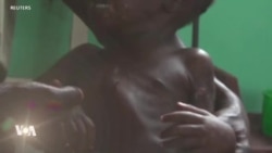 La rougeole se propage à l’ombre du Covid-19 en RDC