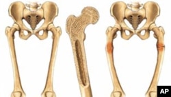 شکستگی ها در استخوان های حوصله و ران یکی از مشکلات عمدۀ کهنسالان عنوان شده است.