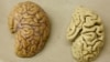 FILE - One hemisphere of a healthy brain (L) is pictured next to one hemisphere of a brain of a person suffering from Alzheimer disease.
