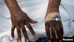 Les mains d'un patient souffrant d'éruptions cutanées causées par le virus mpox. Kinshasa, 30 août 2024. Reuters / Justin Makangara