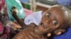 In this Tuesday, July 26, 2011 file photo, then seven month old Somali boy Minhaj Gedi Farah is treated in a field hospital of the International Rescue Committee (IRC) in Dadaab, Kenya. Somalia was hard hit by drought and parts of the country suffered fam