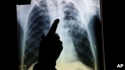 결핵 환자의 X-레이 사진. (자료사진)